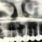Rx di terapia endodontica di monconi da 13 a 23